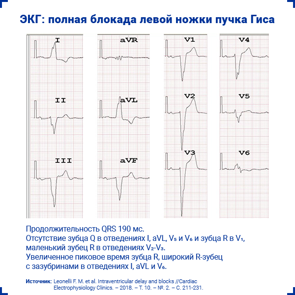 ЭКГ полная блокада левой ножки пучка Гиса